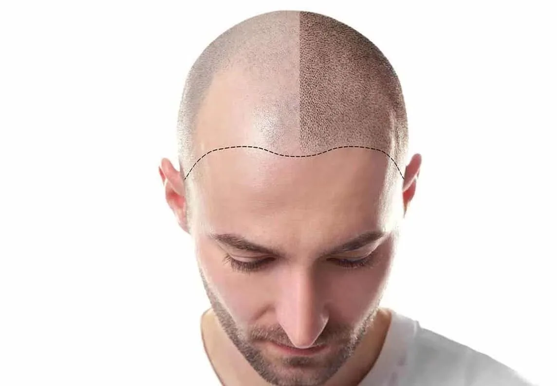 Injerto capilar - SIMONE TRICHOLOGY