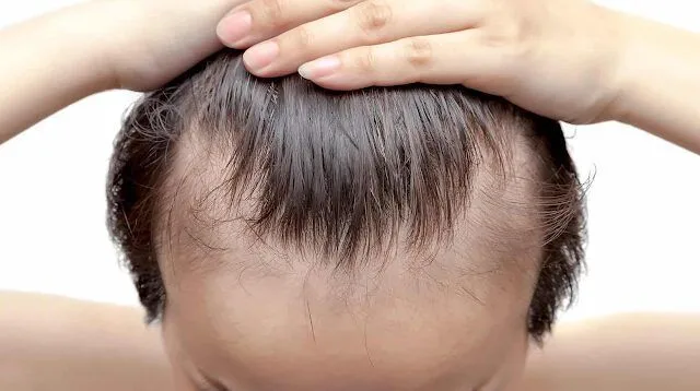 HAIR LOSS AND ALOPECIA | SIMONE TRICHOLOGY